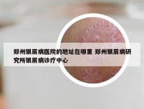 郑州银屑病医院的地址在哪里 郑州银屑病研究所银屑病诊疗中心