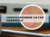 20多岁为什么突然的银屑病 30多了突然引起银屑病怎么办
