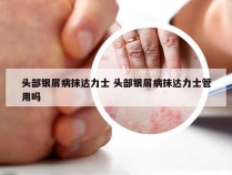 头部银屑病抹达力士 头部银屑病抹达力士管用吗