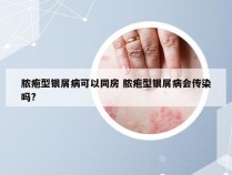 脓疱型银屑病可以同房 脓疱型银屑病会传染吗?
