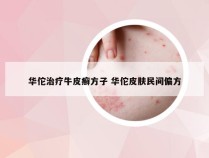 华佗治疗牛皮癣方子 华佗皮肤民间偏方