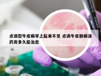 点滴型牛皮癣早上起来不见 点滴牛皮肤癣涂药膏多久能治愈