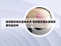 链球菌性咽炎是银屑病 链球菌性咽炎是银屑病引起的吗