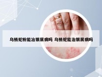 乌梢蛇粉能冶银屑病吗 乌梢蛇能治银屑病吗