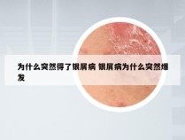 为什么突然得了银屑病 银屑病为什么突然爆发