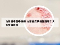 山东省中医牛皮癣 山东省皮肤病医院哪个大夫看银屑病