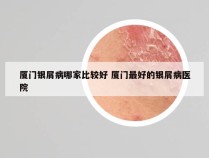 厦门银屑病哪家比较好 厦门最好的银屑病医院
