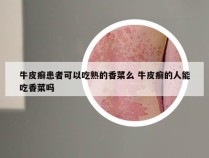 牛皮癣患者可以吃熟的香菜么 牛皮癣的人能吃香菜吗