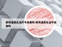 防风通圣丸治疗牛皮癣吗 防风通圣丸治牛皮鲜吗