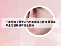 牛皮癣喝了藿香正气水的功效与作用 藿香正气水治银屑病有什么特效