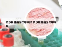 长沙银屑病治疗哪家好 长沙银屑病治疗哪家好