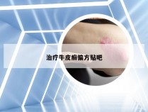 治疗牛皮癣偏方贴吧