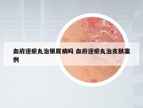 血府逐瘀丸治银屑病吗 血府逐瘀丸治皮肤案例