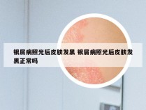 银屑病照光后皮肤发黑 银屑病照光后皮肤发黑正常吗
