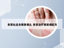 青黛丸适合银屑病么 青黛治疗银屑病配方