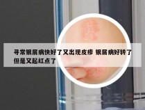 寻常银屑病快好了又出现皮疹 银屑病好转了但是又起红点了