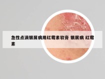 急性点滴银屑病用红霉素软膏 银屑病 红霉素