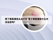 得了银屑病怎么治疗好 得了银屑病有什么方法治愈吗?