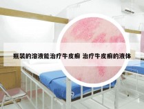 瓶装的溶液能治疗牛皮癣 治疗牛皮癣的液体