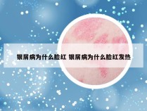 银屑病为什么脸红 银屑病为什么脸红发热