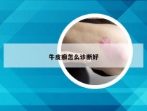 牛皮癣怎么诊断好