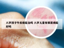 八岁孩子牛皮癣能治吗 八岁儿童有银屑病能好吗