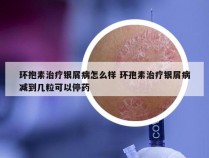 环抱素治疗银屑病怎么样 环孢素治疗银屑病减到几粒可以停药