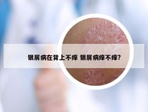 银屑病在背上不痒 银屑病痒不痒?