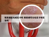 银屑病能吃咸瓜子吗 银屑病可以吃瓜子和花生吗