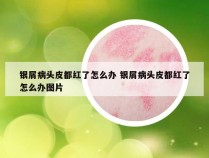 银屑病头皮都红了怎么办 银屑病头皮都红了怎么办图片
