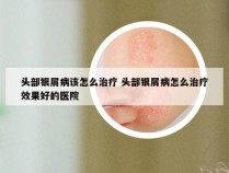头部银屑病该怎么治疗 头部银屑病怎么治疗效果好的医院