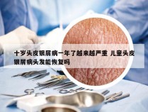 十岁头皮银屑病一年了越来越严重 儿童头皮银屑病头发能恢复吗