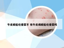 牛皮癣能吃香菜不 有牛皮病癣能吃香菜吗