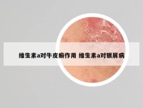 维生素a对牛皮癣作用 维生素a对银屑病