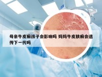 母亲牛皮癣孩子会影响吗 妈妈牛皮肤癣会遗传下一代吗