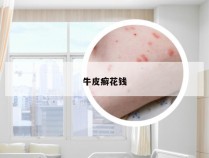 牛皮癣花钱