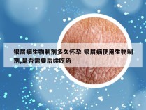 银屑病生物制剂多久怀孕 银屑病使用生物制剂,是否需要后续吃药