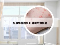 轻度银屑病指炎 轻度的银屑病