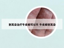 割耳朵治疗牛皮癣可以不 牛皮癣划耳朵