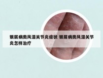 银屑病类风湿关节炎症状 银屑病类风湿关节炎怎样治疗