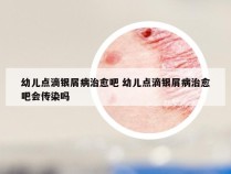 幼儿点滴银屑病治愈吧 幼儿点滴银屑病治愈吧会传染吗