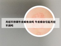 月经不停跟牛皮癣有关吗 牛皮癣会引起月经不调吗