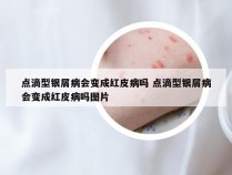 点滴型银屑病会变成红皮病吗 点滴型银屑病会变成红皮病吗图片