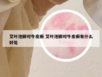 艾叶泡脚对牛皮癣 艾叶泡脚对牛皮癣有什么好处