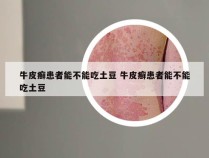 牛皮癣患者能不能吃土豆 牛皮癣患者能不能吃土豆
