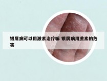 银屑病可以用激素治疗嘛 银屑病用激素的危害
