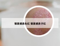 银屑病鼻头红 银屑病鼻子红