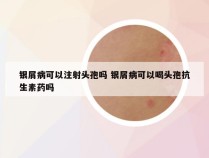 银屑病可以注射头孢吗 银屑病可以喝头孢抗生素药吗