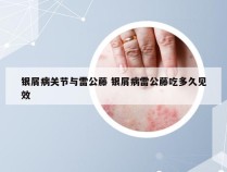 银屑病关节与雷公藤 银屑病雷公藤吃多久见效