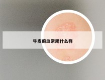 牛皮癣血常规什么样